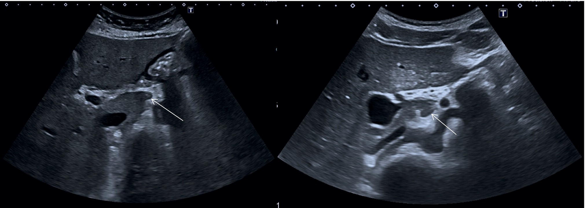 Two photographs and scanned images. The photographs of scanning on the stomach. a. The inferior vena cava in segment 2. b. I V B in the segments 3 are depicted.