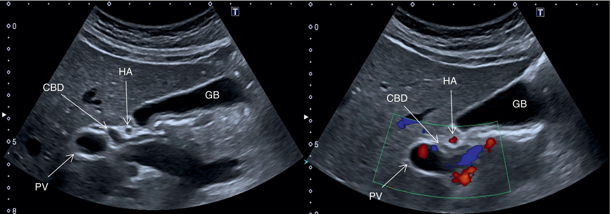 Three photographs and scanned images. Three photographs of scanning procedure on the stomach. The inferior vena cava, left portal vein, right atrium in the segment 1 and 4, 4, 2 and 3 are depicted respectively.