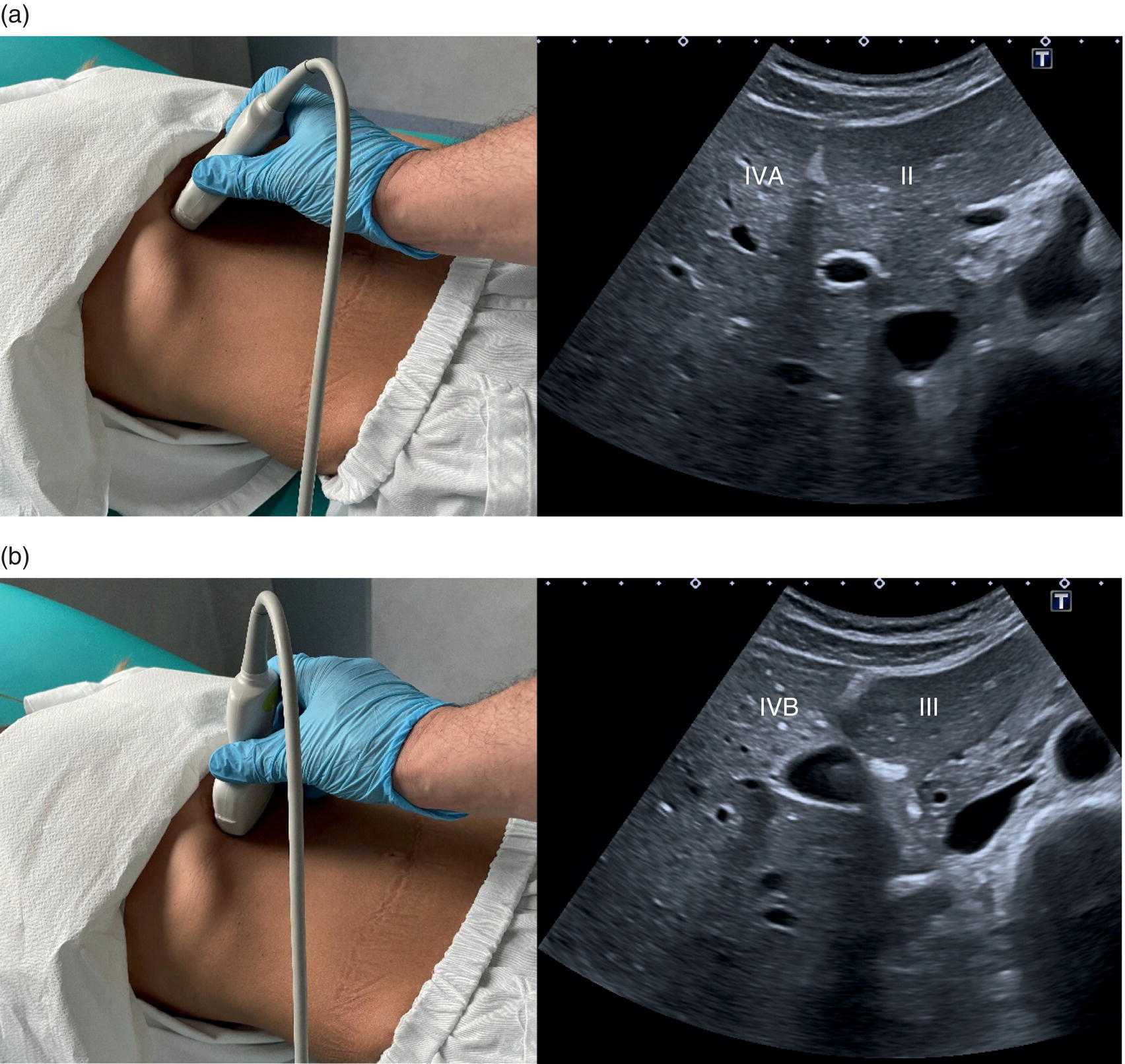 Five photographs and scanned images. The photographs depict the scanning procedure on the stomach. The scan images depict the left branch of the portal vein, inferior vena cava, and gall bladder in segments 1 to 8. The inferior vena cava, portal vein, and gall bladder are in segments 4 and 5. 4, 5, and 8. Gallbladder in segments 1, 4 to 8. Portal vein and inferior vena cave in segments 1, 3 to 8 are depicted.