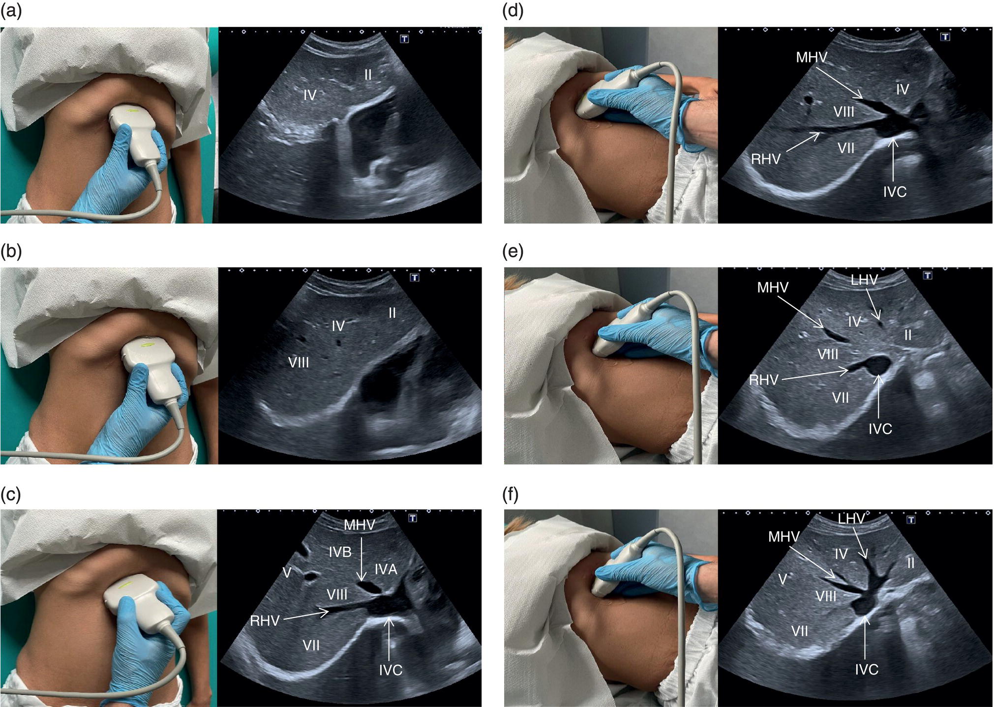 Six photographs and scanned images. The photographs depict the scanning procedure on the stomach. The scan images depict the gall bladder, left branch of the portal vein, inferior vena cava in segments 4 and 5. The inferior vena cava, portal vein, right portal vein, and gall bladder are depicted.