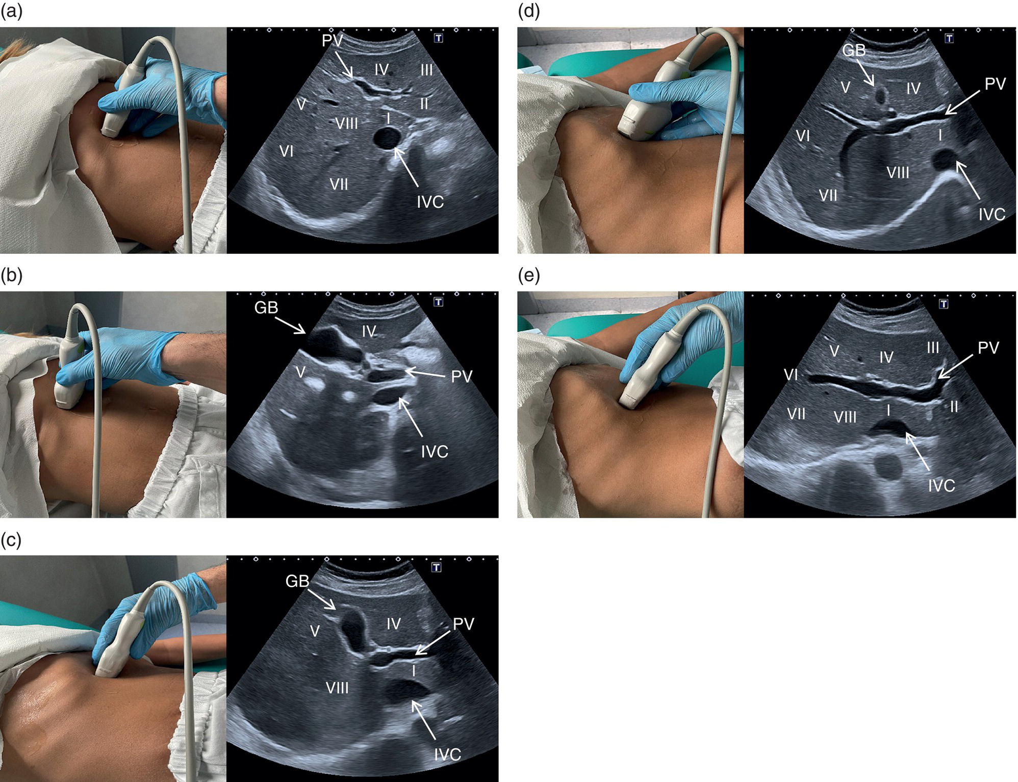 A photograph and a scanned image. The photographs depict the scanning procedure on the stomach. The scanned image depicts the portal vein, inferior vena cava, portal vein, and common bile duct.