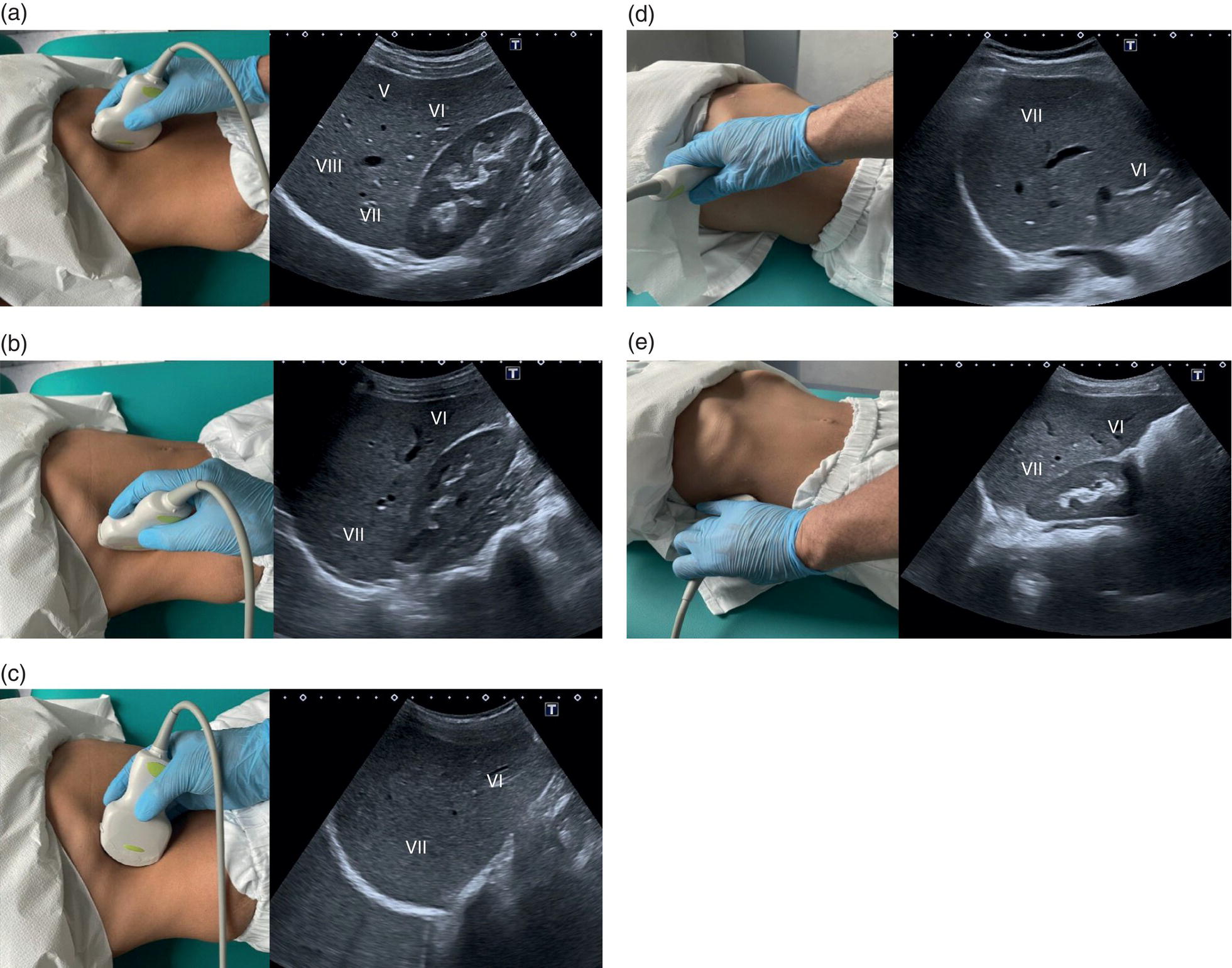 A scan image. The common bile duct, portal vein, hepatic artery, and inferior vena cava are depicted. It is measured at 4.8 millimeters.