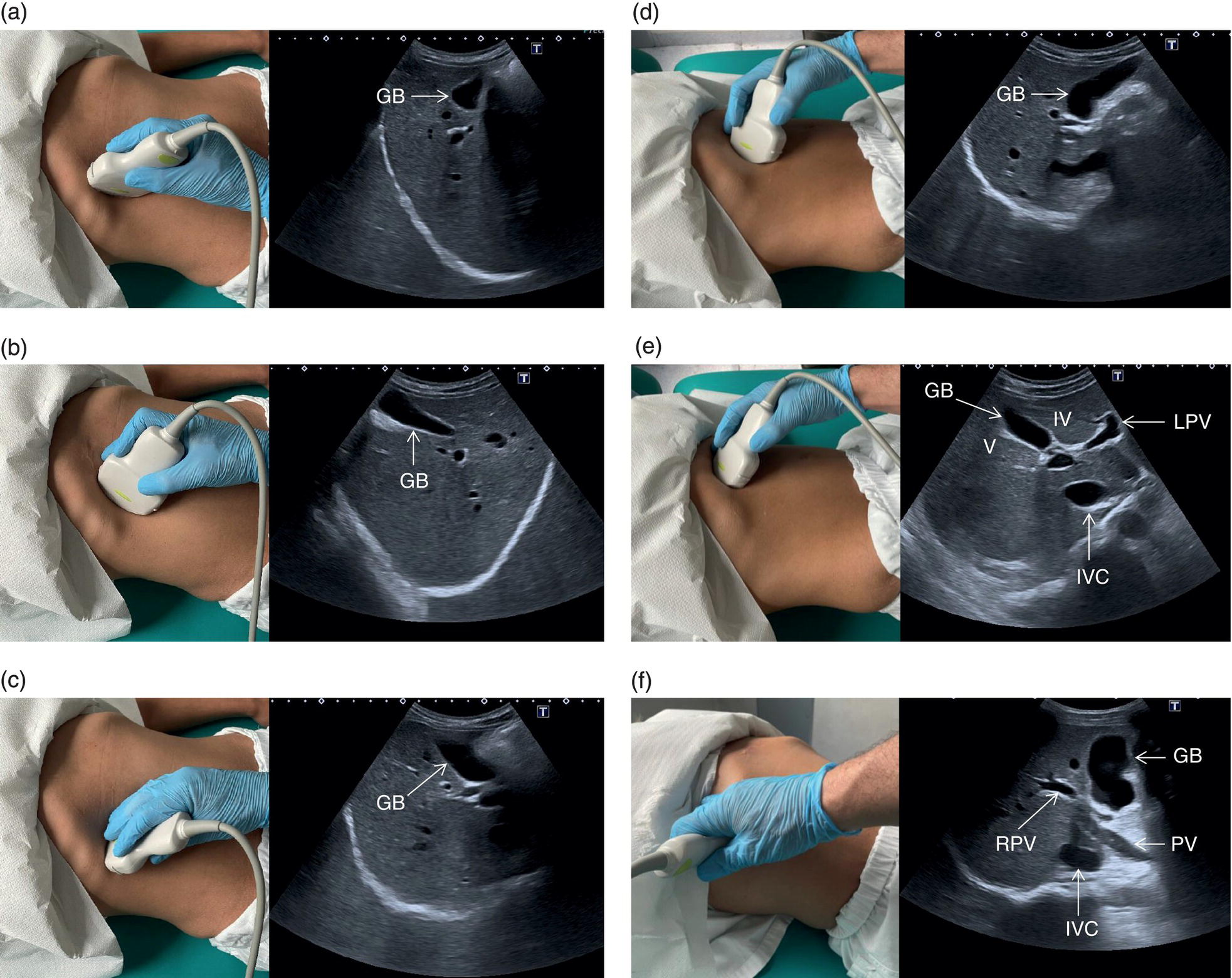 A scan image. The common bile duct, portal vein, hepatic artery, and inferior vena cava are depicted.