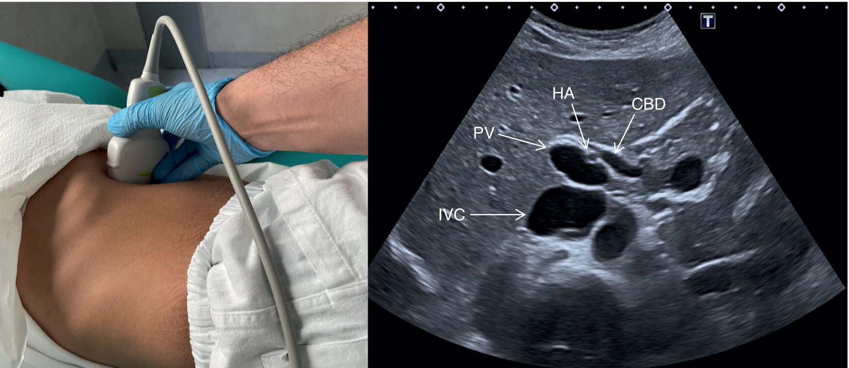 Three photographs and scanned images. The photographs depict the scanning procedure on the stomach. The scanned images depict the inferior vena cava, gall bladder, portal vein, inferior vena cava, and common bile duct are highlighted with arrows.