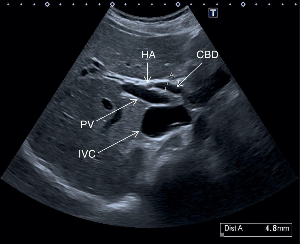 Two scan images. a. It depicts the right portal vein, gall bladder, inferior vena cava, and extrahepatic portal vein. b. Inferior vena cava, and extrahepatic portal vein.