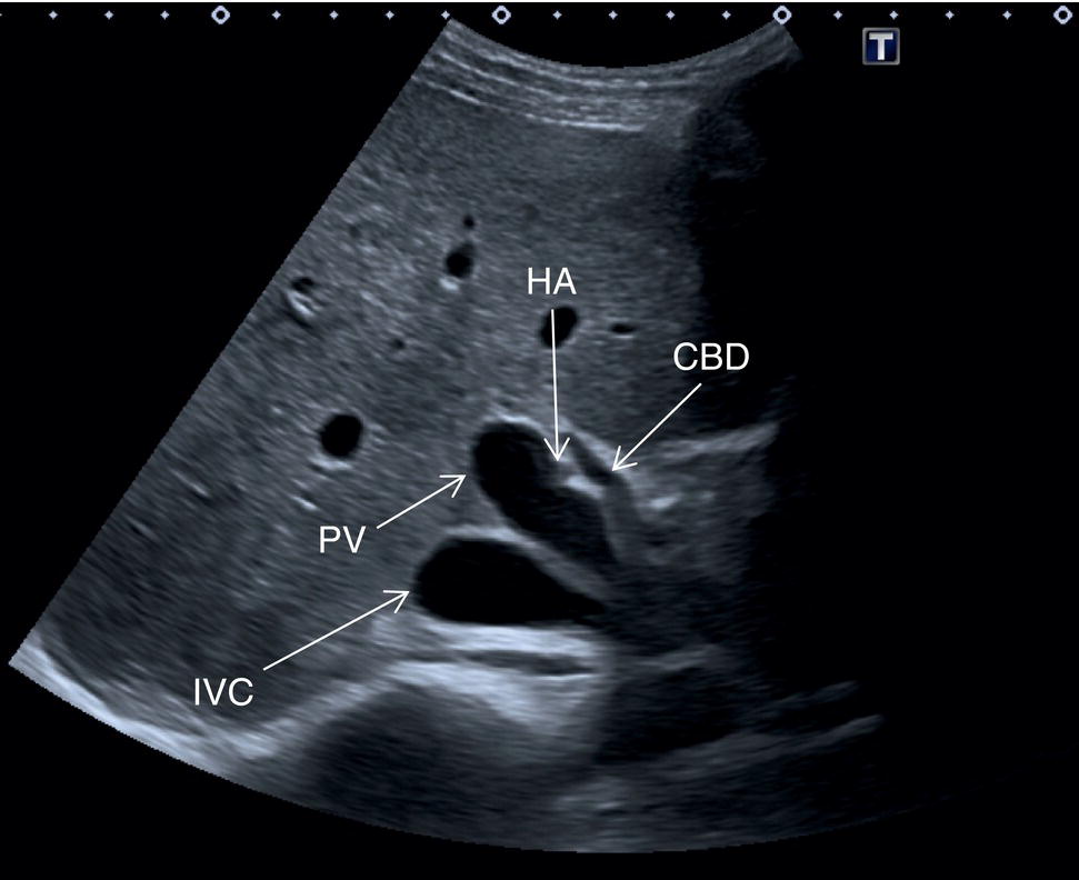 Three photographs and scanned images. The photographs depict the scanning procedure on the stomach. a. The scanned images depict the pancreas, superior mesenteric artery, and splenic vein. b. Superior mesenteric vein. c. Portal vein.