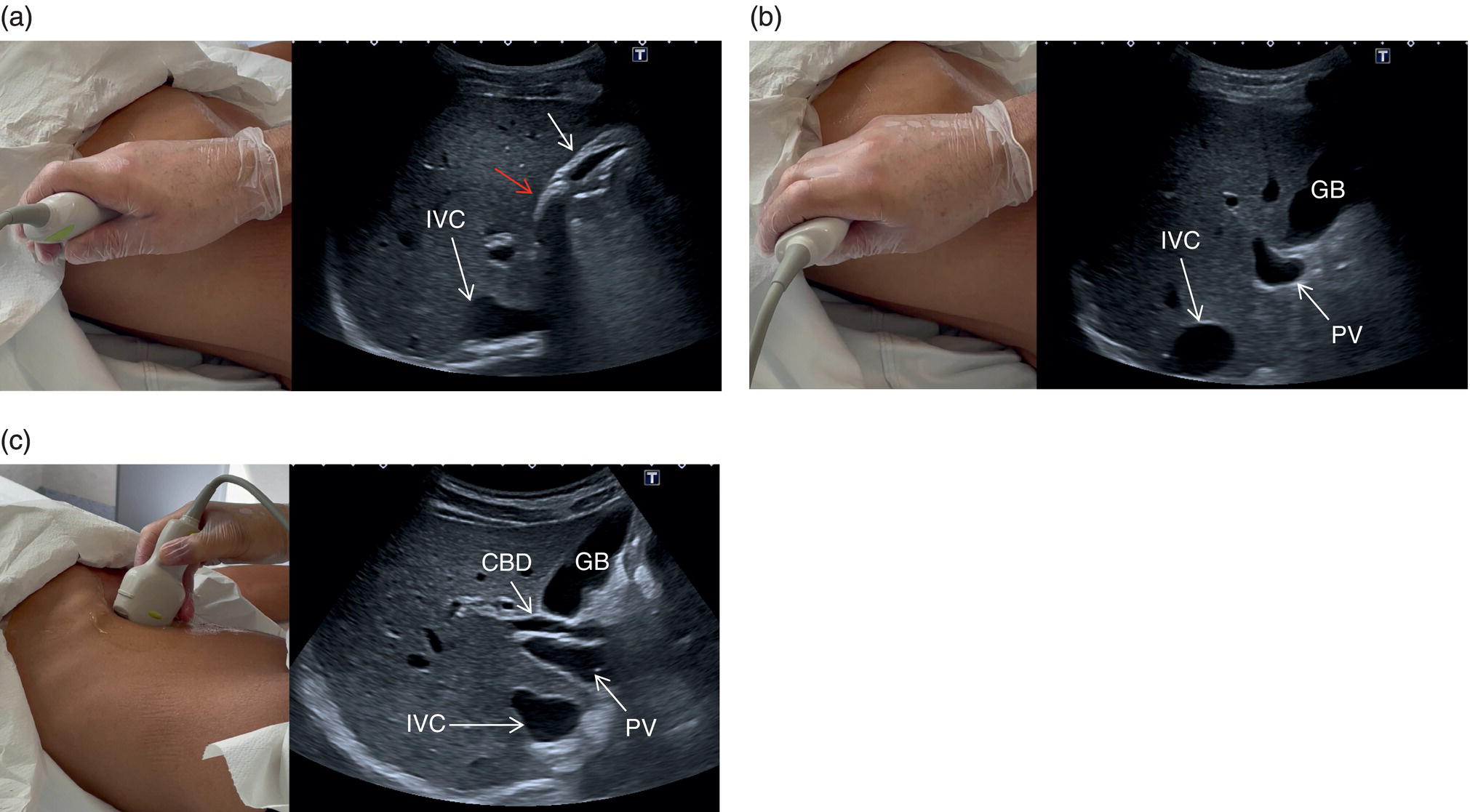 A scan image depicts the portal vein, hepatic artery, and common bile duct. It is measured at 10.5 millimeters.