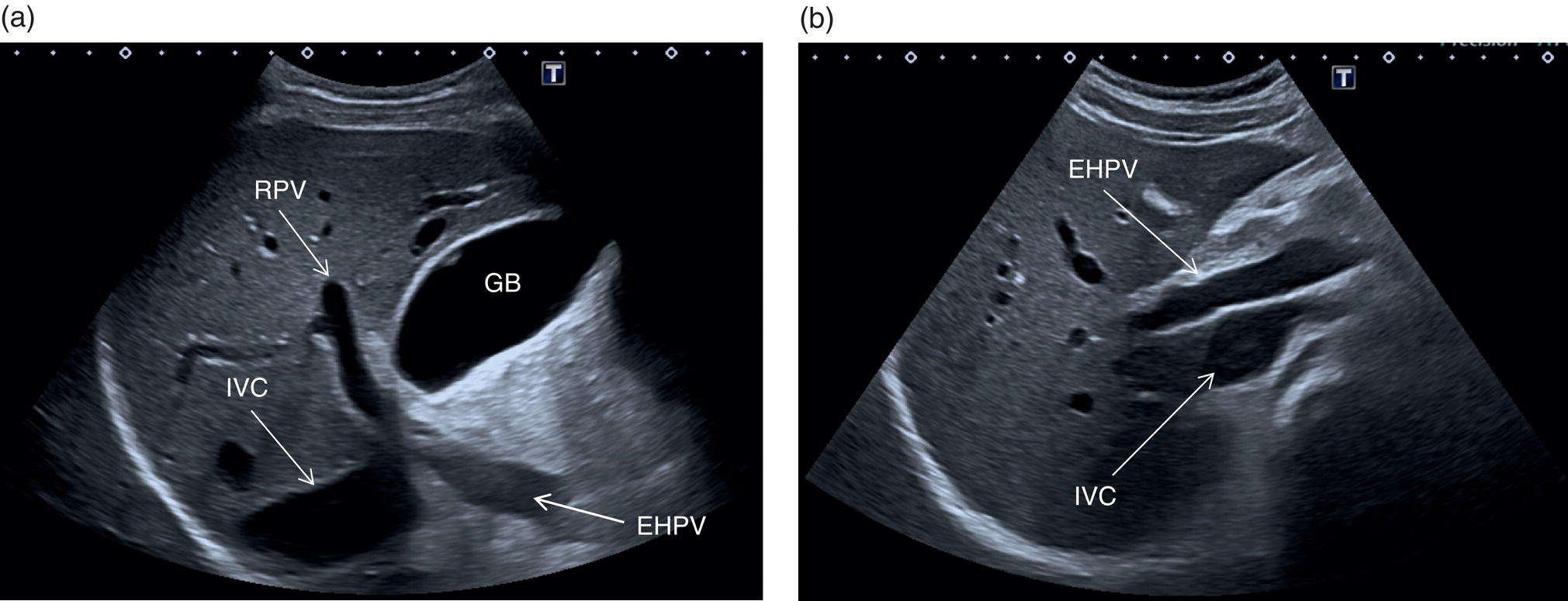 Three scan images. a. The hepatic veins and portal vein. b. The left and right hepatic veins, and medium hepatic veins. c. The portal vein are depicted.