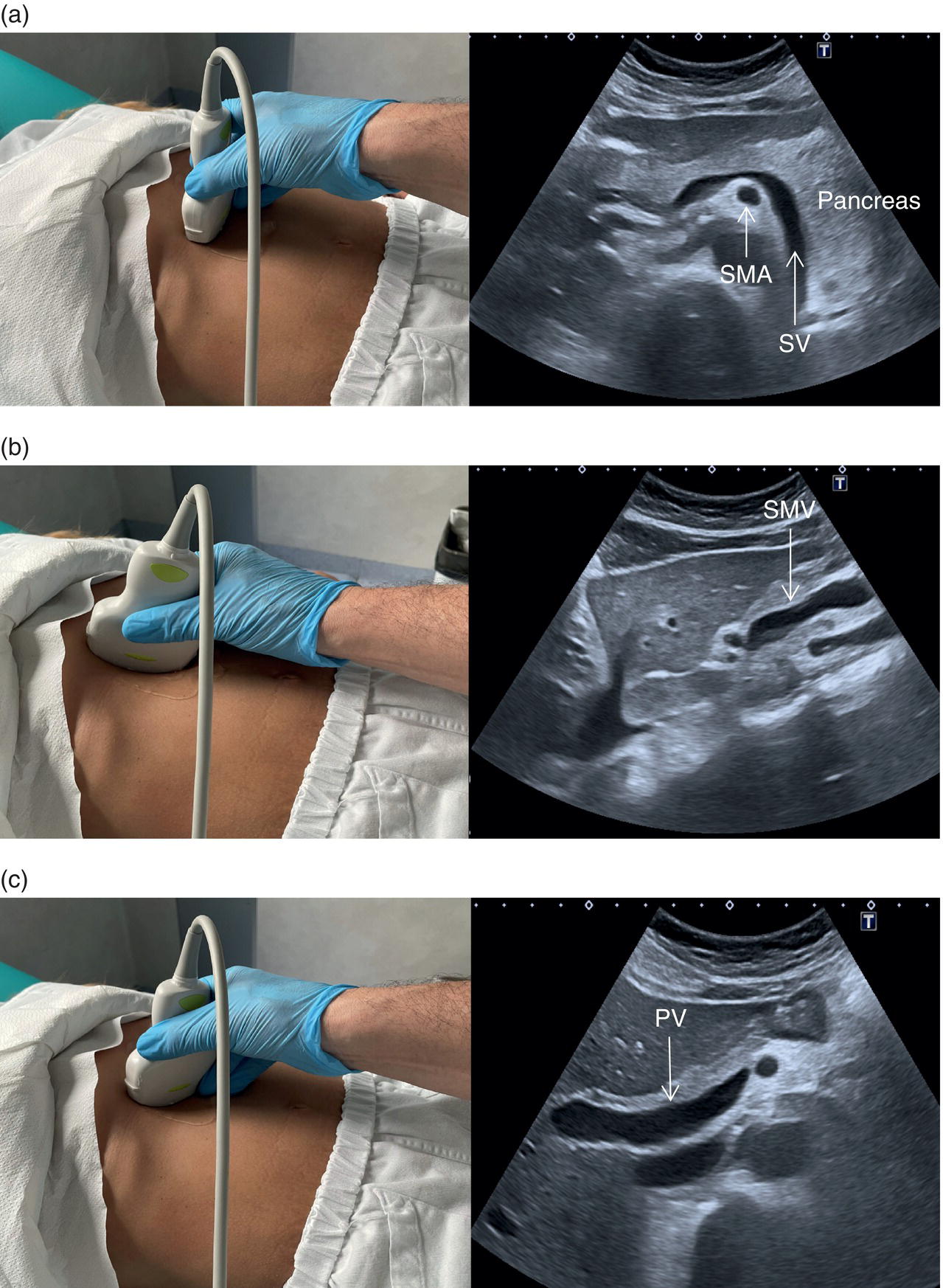 A radiograph depicts the measurement of the portal venous flow level of the main portal vein. P I 0.36. R I 0.25. V max A 30.5. V e d A 22.8. V min A 21.0. A m p A 26.2. S per D A 1.34.