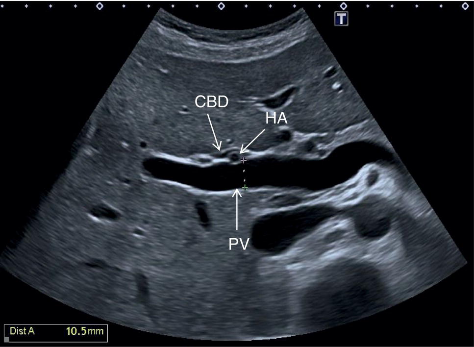 A radiograph and a scan image. a. The hepatic veins are highlighted in a box. b. The measurement and analysis of triphasic flow.