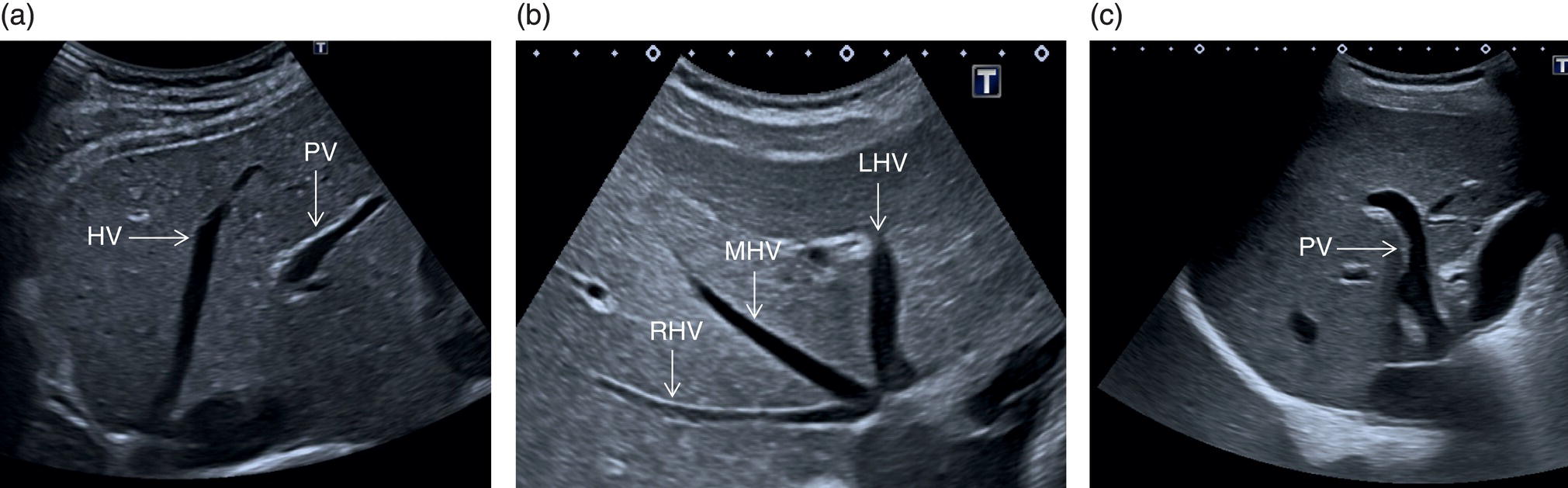 A radiograph depicts the measurement of the hepatic artery flow to the anterior portal vein. P I 0.82. R I 0.54. V max A 56.6. V e d A 26.1. V min A 26.0. V m p A 37.4. V m m A 21.1. S per D A 2.16.