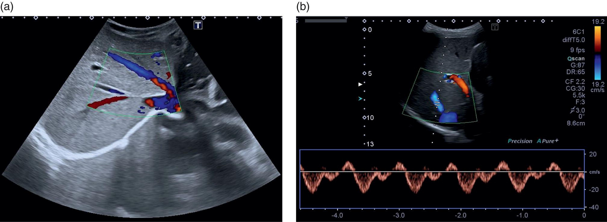 Four sets of diagrams, real, and radiograph images. a to d. Dorsal view of liver segmentation. a to d. The ventral view depicts the portal triad, gall bladder, and vena cava. a to d. The pictorial view of dorsal and ventral surfaces of the liver, and liver segments, depicts the portal triad, L H V, M H V, R H V, I V C, P V, and G B.