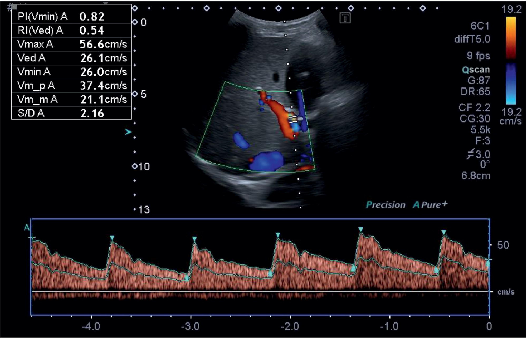 A radiograph depicts three images of diaphragmatic slip fissures at the liver surface highlighted with arrows.