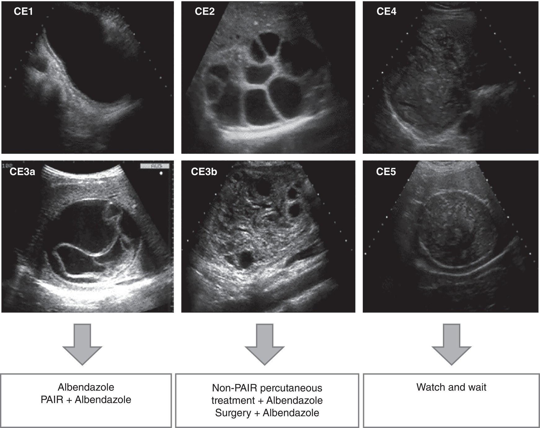 Six ultrasound scan images are arranged in two rows and three columns. They are titled as follows. C E 1, C E 2, C E 3, C E 4, C E 3a, C E 3b, C E 5. Below the first column labeled Albendazole P A I R + Albendazole. Below the second column labeled Non-P A I R percutaneous treatment + Albendazole Surgery + Albendazole. Below the third column labeled watch and wait.