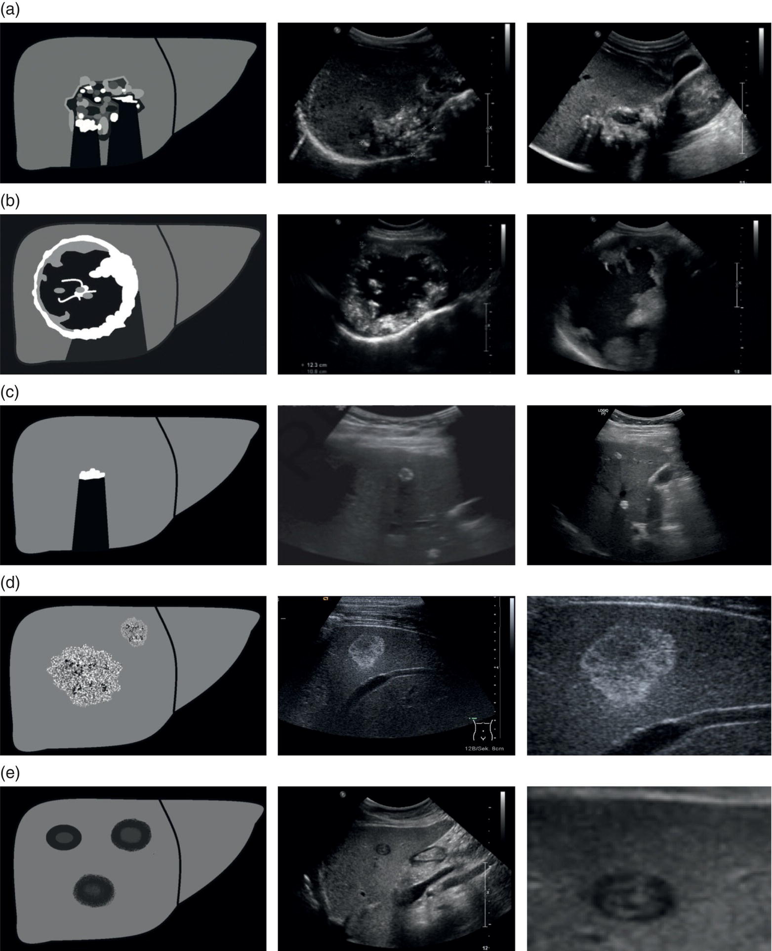 Five sonographic patterns of different ultrasound images. a. Hailstorm. b. pseudocystic. c. ossification. d. hemangioma. e. metastais. It contains three columns. The first column depicts the five sonographic patterns, and the second and the third column contains their respective ultrasound images.