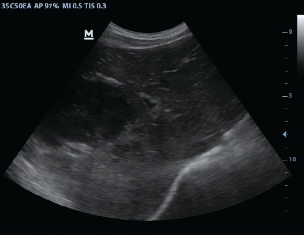 An ultrasound scan image of round hypoechoic amoebic liver abscess without significant walls in the dorsal segments of the right lobe.