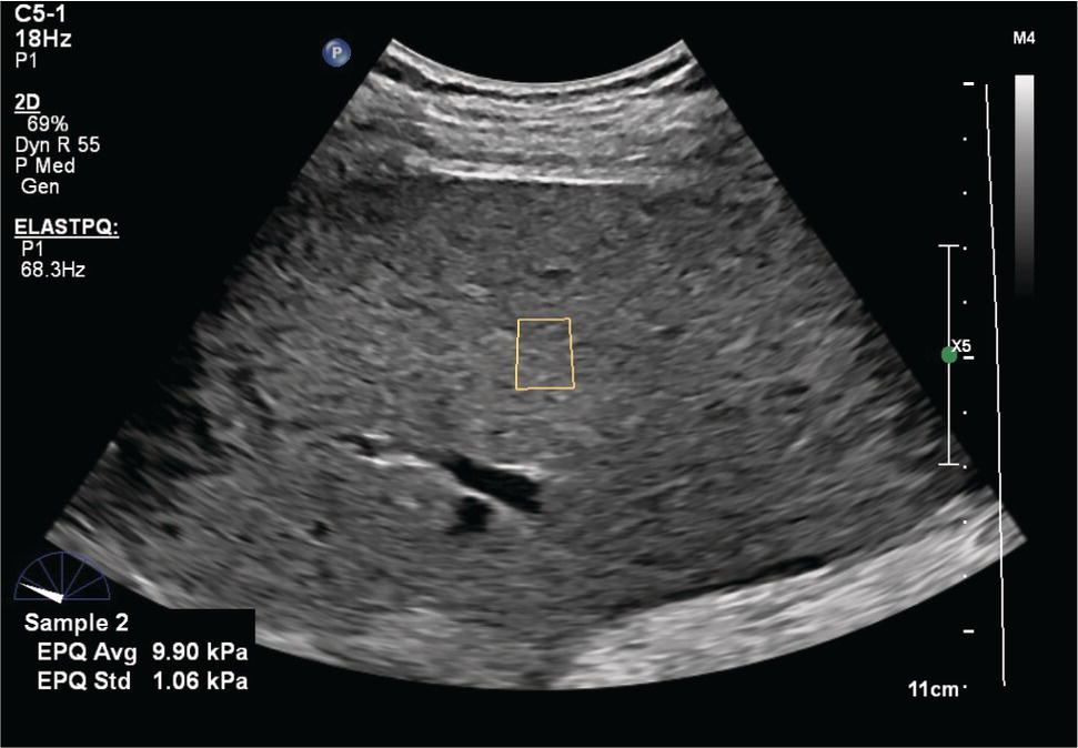 An ultrasound scan image of the liver demonstrates the shear wave elastography, region of interest, and the mean value of the push-track sequences with the standard deviation.