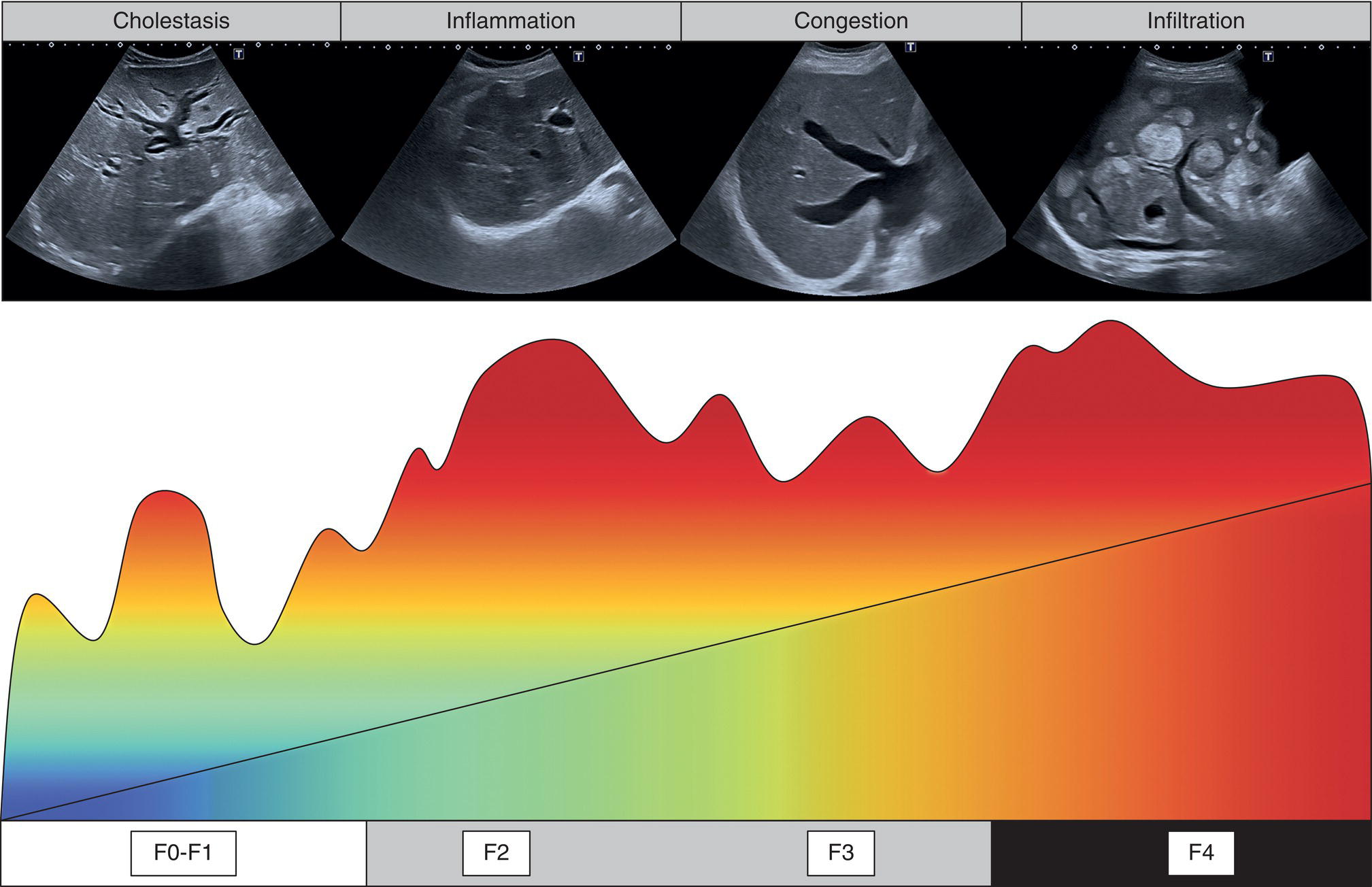 Four scan images and a elastography scale. The scan images depict cholestasis, inflammation, congestion, and infiltration. The trend is increasing over the four stages from F 0 to F 4.