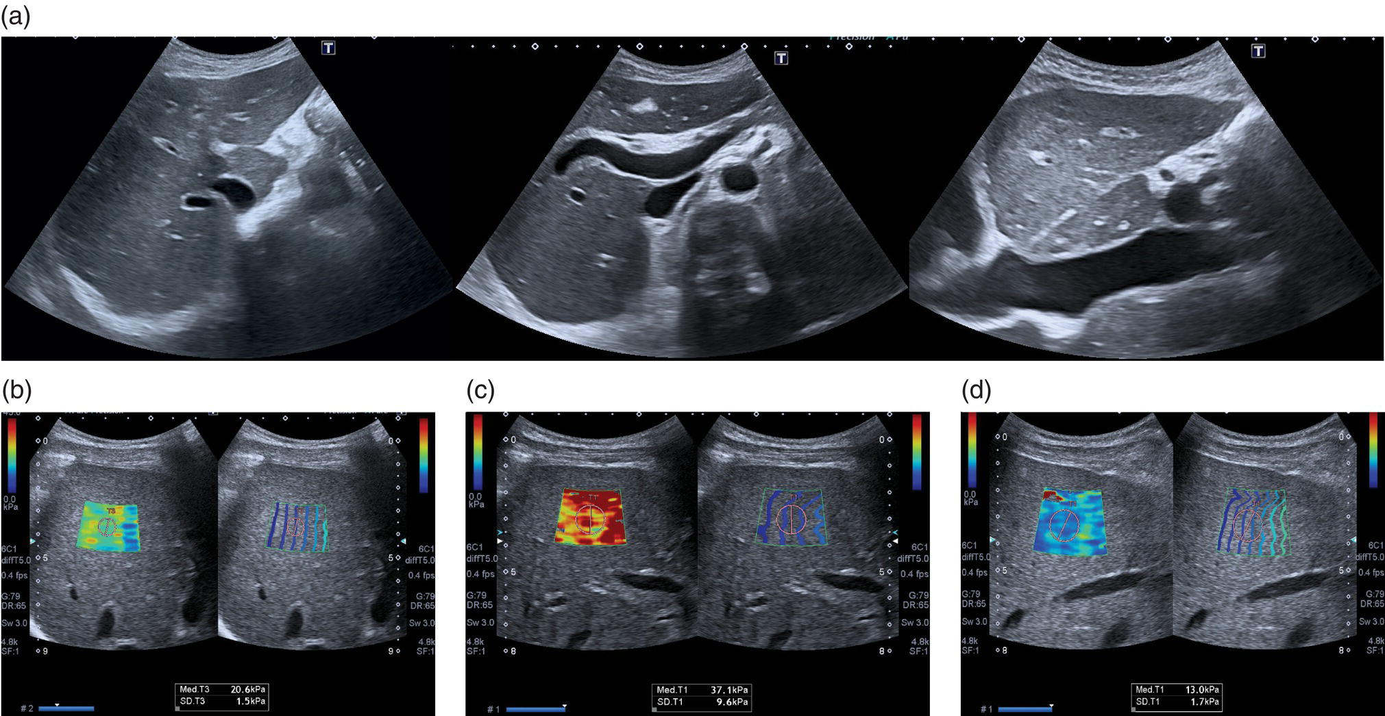 Two sets of scan images. A. The scan images shows the features in keeping with chronic liver disease. (b) The scan image shows the high LS results in keeping with cirrhosis. (c) At one week biochemistry showed further worsening of liver function tests and transaminase, with a simultaneous increase of L S. (d) Liver biopsy was carried out and the patient was commenced on high-dose steroids.