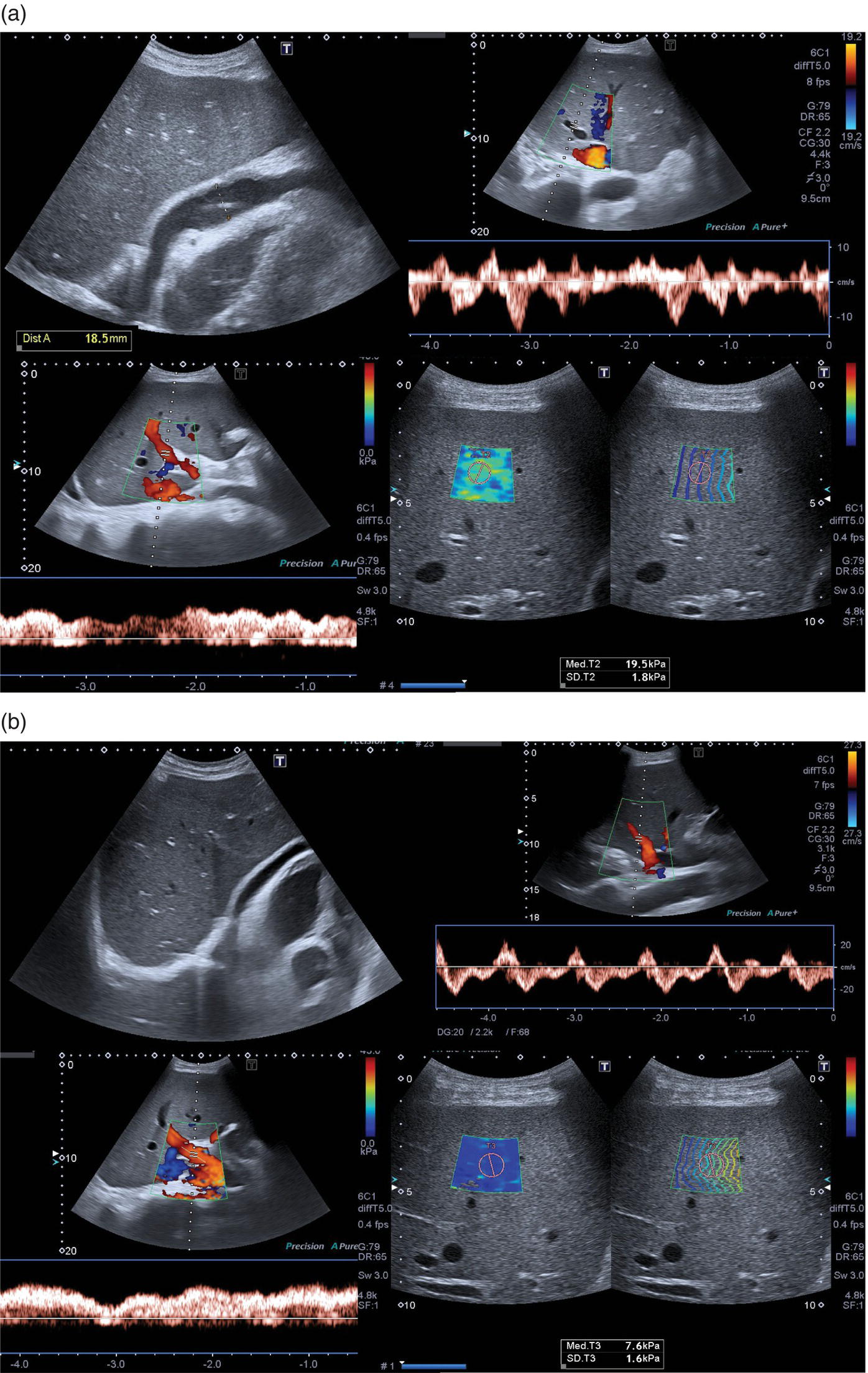 Two sets of ultrasound scan images of a patient with polyserositis complicated by pericardial effusion and severe hypotension. (a) The scan images show hepatic congestion secondary to dynamic cardiac outflow obstruction with pulsatile portal venous flow and deranged spectral waveform of the hepatic veins. (b) After large-volume fluid infusion and anti-inflammatory treatment, there was significant reduction of the pericardial effusion.