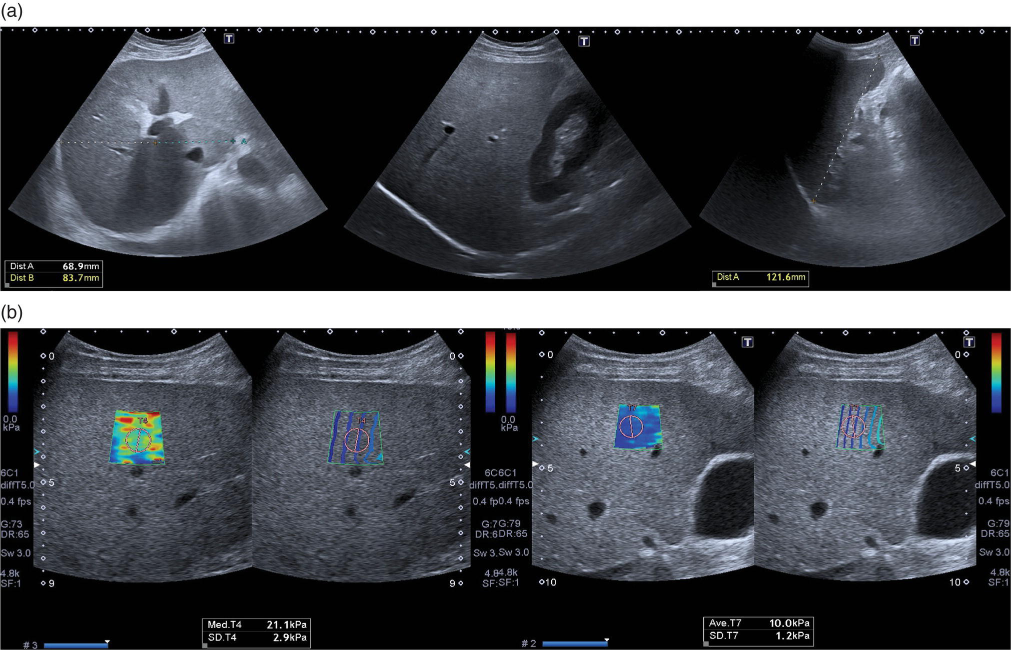 Two sets of scan images of a patient admitted to hospital with clinical and biochemical features of alcohol hepatitis and no known history of liver disease. (a) It shows caudate lobe or right lobe ratio greater than 65 and initial margin retraction in keeping with chronic liver disease, but a smooth liver contour and no splenomegaly. (b) Elastography on admission revealed a liver stiffness value of 21. 1 kilopascals and subsequent significant reduction of almost 10 kPa at one week after detoxification (right side).