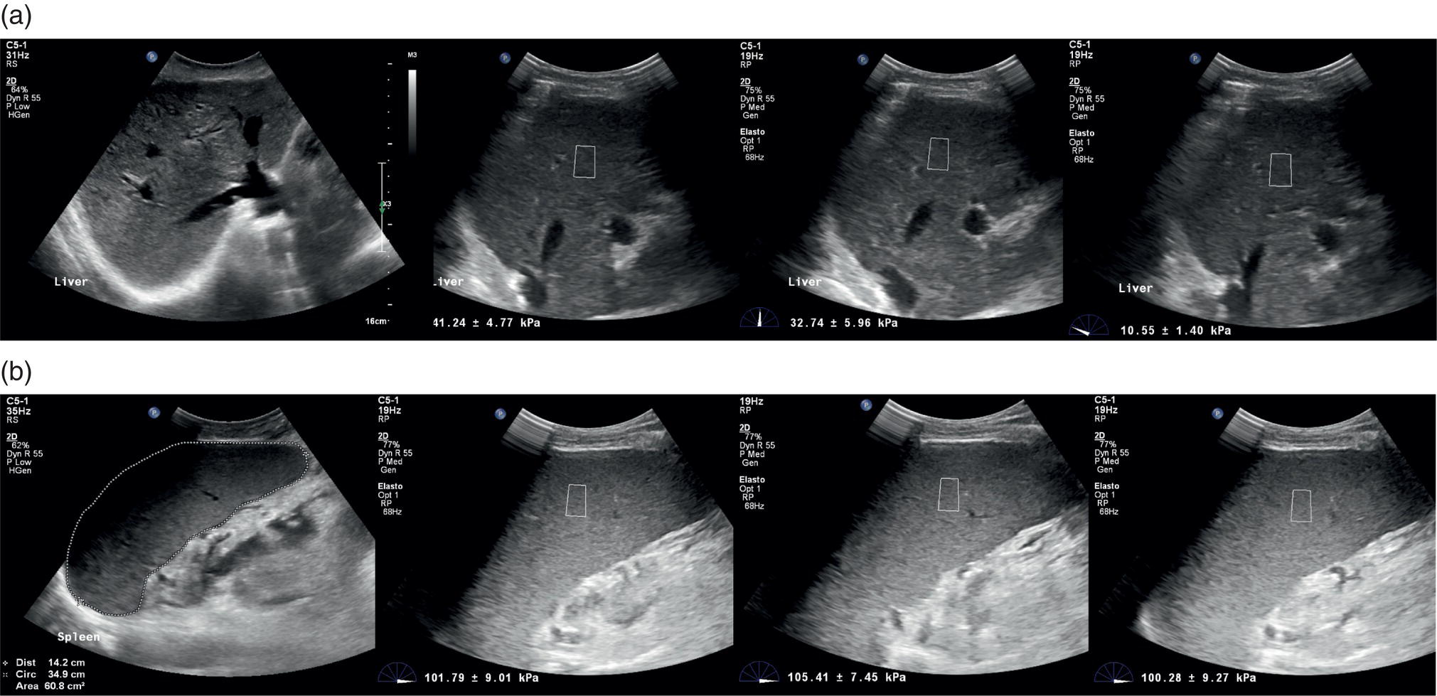 Two sets of ulstrasound scan images of a patient with primary biliary cholangitis with a heterogeneous liver echostructure and high liver stiffness variability (a). It indicates an evidence of homogeneous splenomegaly, with very high but low-variability stiffness values (b). It indicates the higher accuracy of spleen stiffness in predicting clinically significant portal hypertension compared to L S.