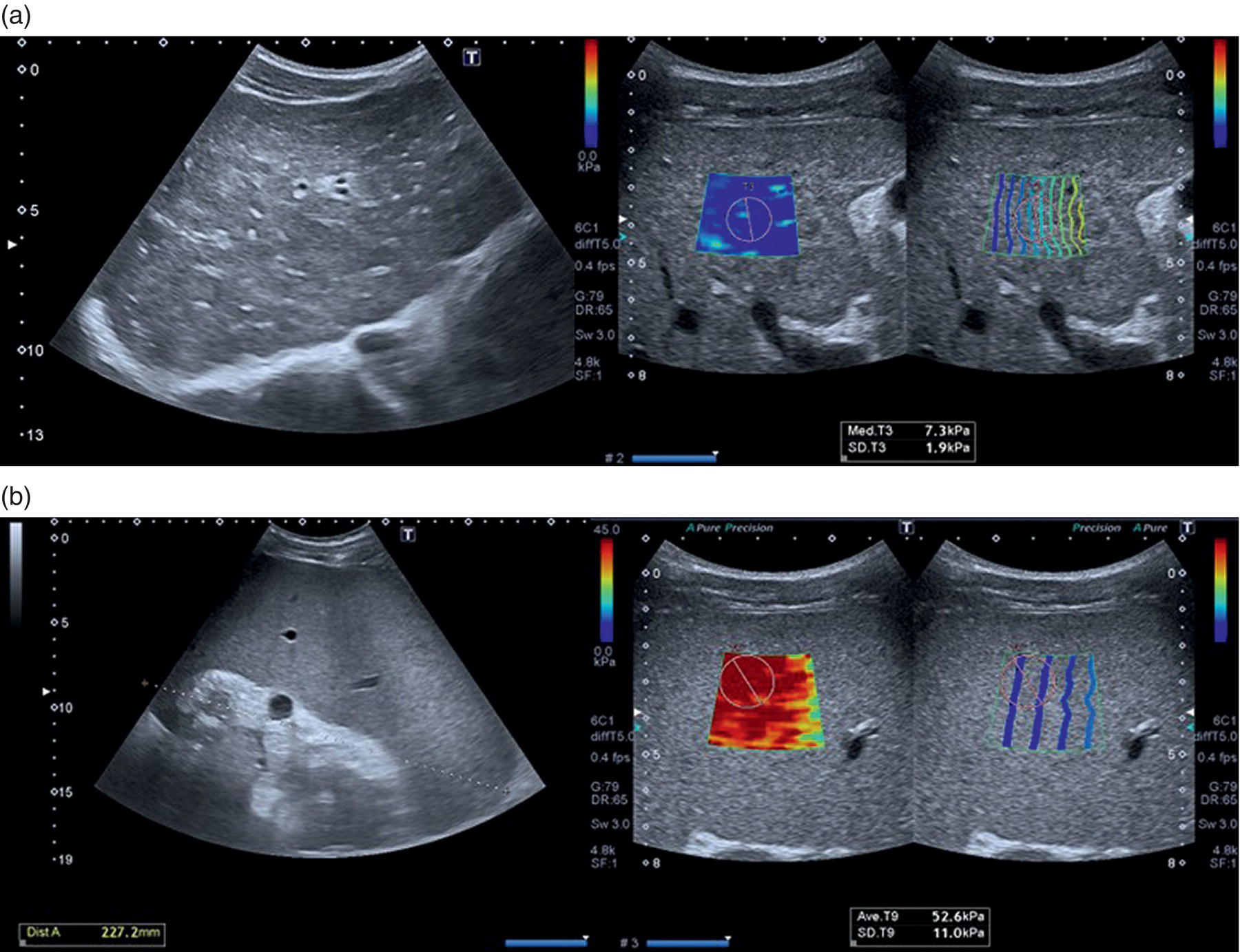 Two sets of scan images (a) heterogeneous liver echotexture with irregular outline and (b) homogeneous splenomegaly.
