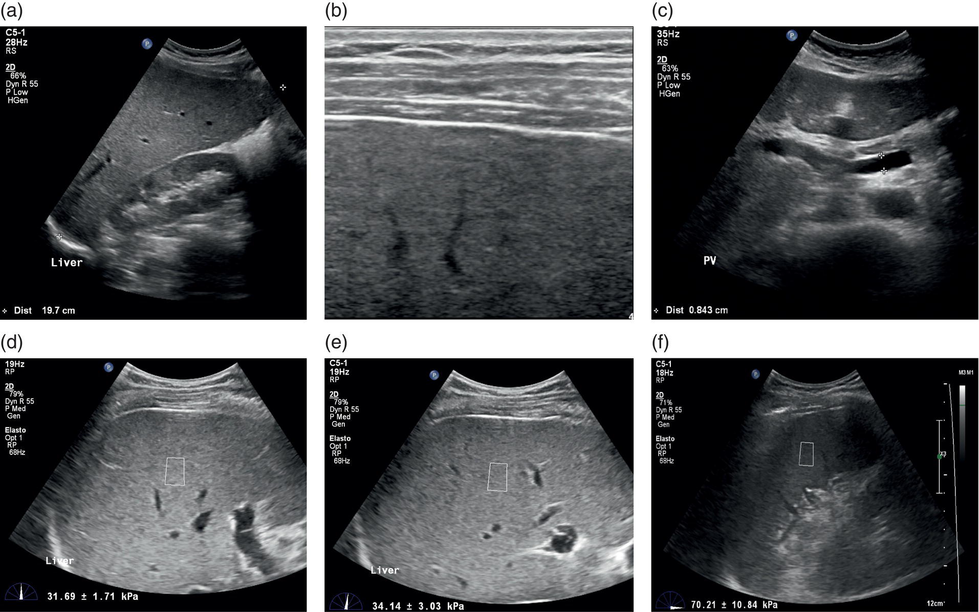 A set of five ultrasounds and one elastography images of a patient affected with chronic liver disease. It displays the liver appearance and sizes of the spleen. A. Uniform echotexture. B. Parenchymal heterogenecity. C. Undilated portal vein type. D and E. Abnormal spleen. F. Testing stiffness.