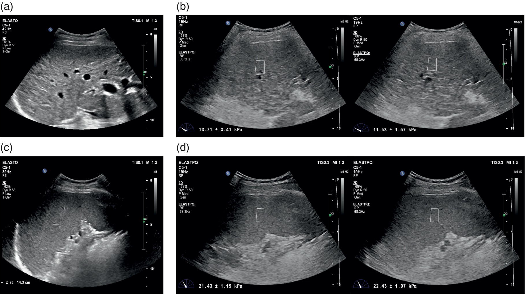 A set of six ultrasound images of a female patient affected by autoimmune hepatitis. A. Smooth outline with uniform echotexture. B. Stiffness testing. It has an increased fibrosis test. C. Display of a moderate splenomegaly. D. Lack of spleen rigidity.
