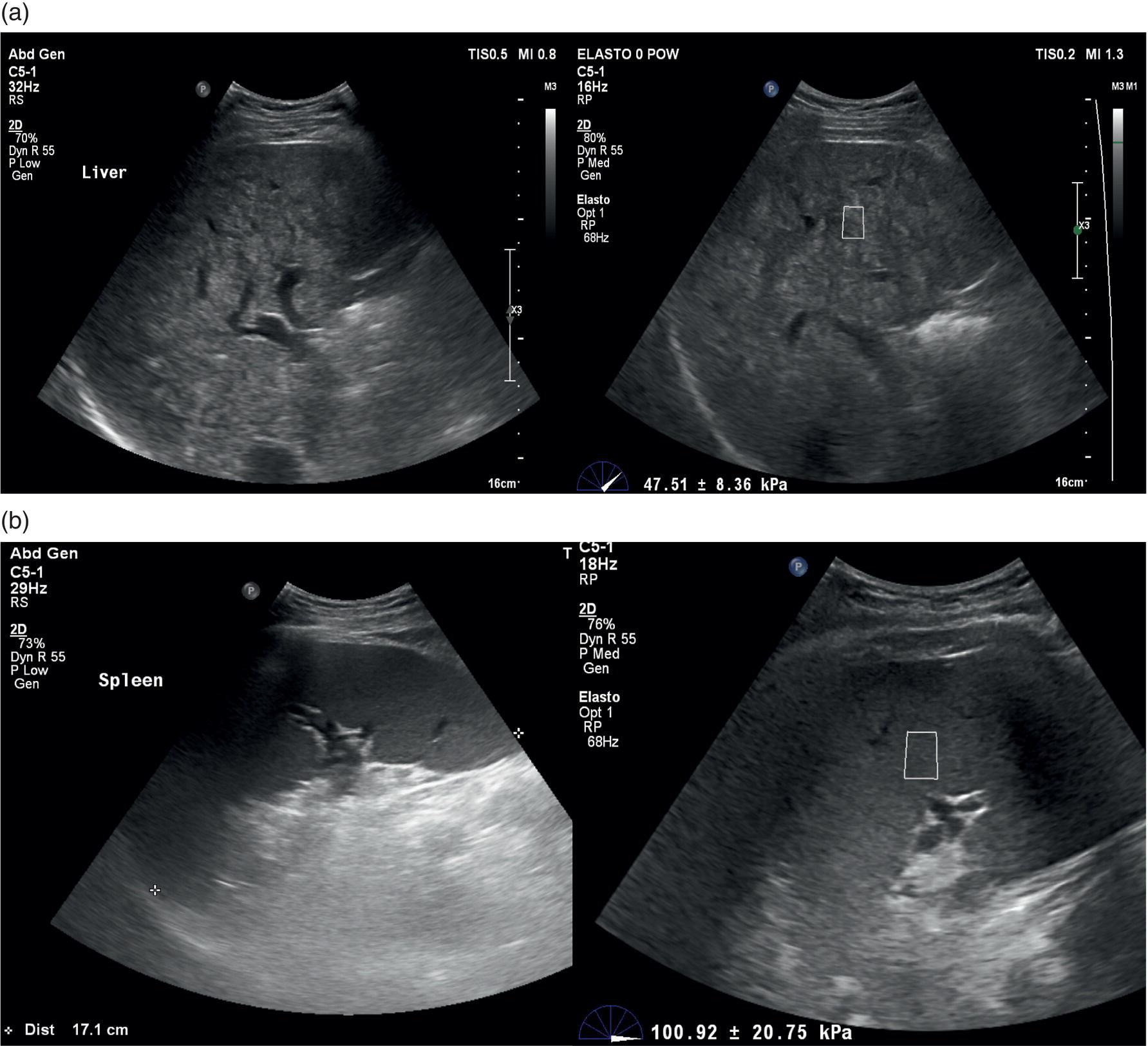 A set of four ultrasounds of a patient affected by steatohepatitis chronic liver disease. A. Two ultrasounds display the liver with a high-level heterogeneous echo texture. B. Spleen display with strong splenomegaly homogeneous stiffness.