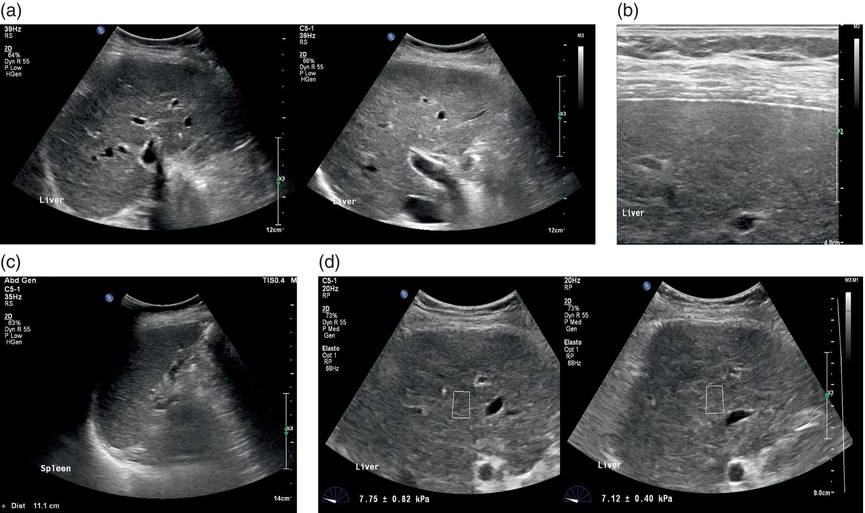 A combination of five ultrasounds and one elastography image of a female patient affected by primary biliary cholangitis. A and b. It displays the liver with a disparate echotexture and a smooth contour. C. The spleen appears to be in a typical state. D. Unusual liver rigidity size.