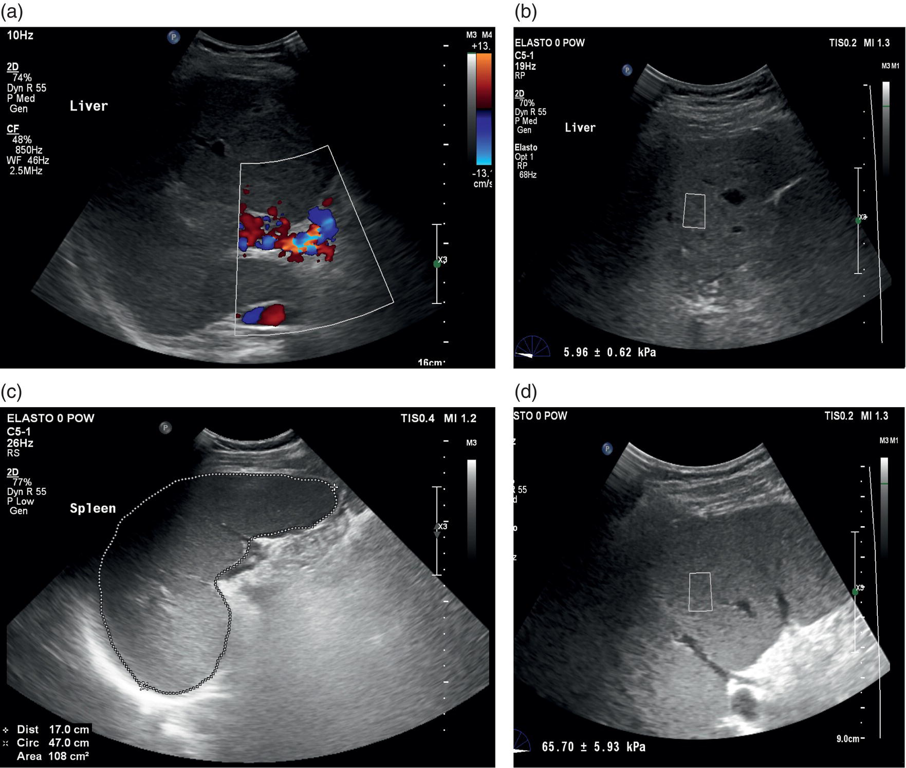 A combination of four ultrasound images exposing the liver and spleen. a. Color Doppler displays the presence of portal vein thrombosis. B. Exposure of an increased liver stiffness. C and d. Pre-hepatic portal hypertension and abnormal spleen stiffness. The structure of the spleen is marked with dotted lines.