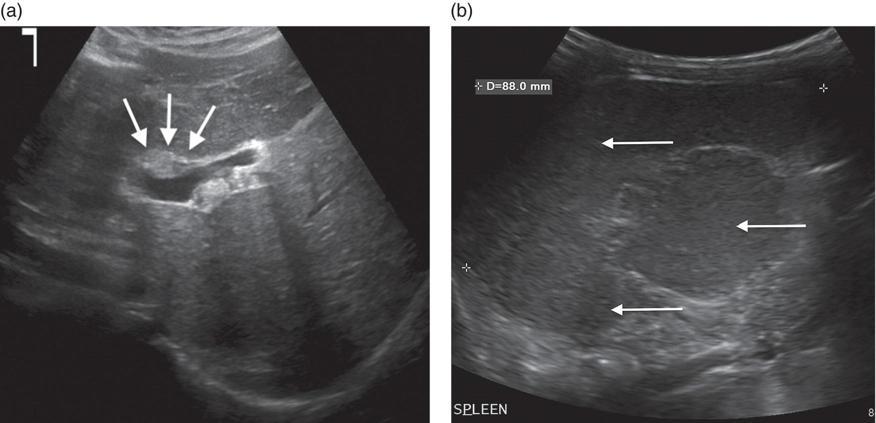 A set of two ultrasounds of a nine-month-old infant affected by biliary atresia and splenic malformation syndrome. A. It displays a triangular-shaped chord sign in the portal vein area denoted by three arrows. B. The spleen exposes polysplenia symptoms denoted by three arrows.