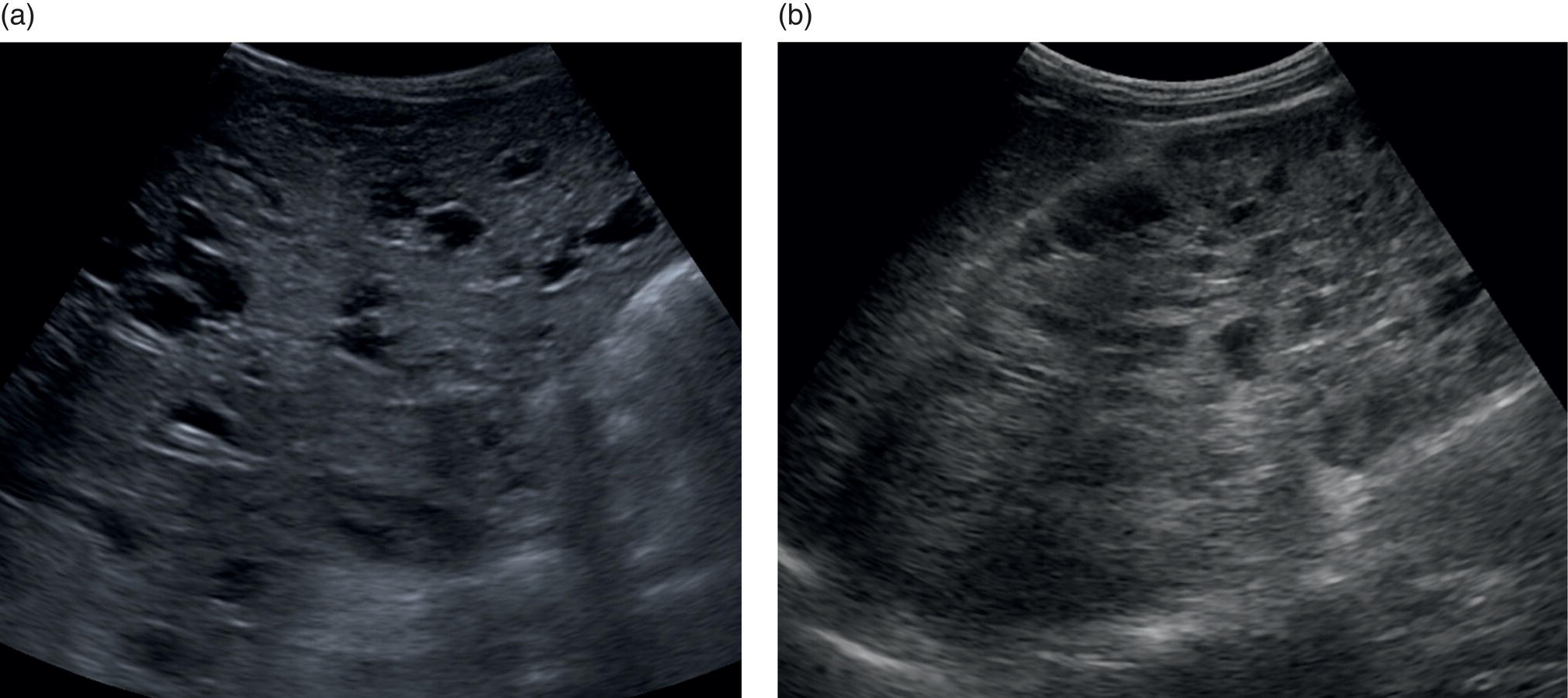 A set of two ultrasounds of a 3-year-old baby affected by Caroli syndrome. A. The liver exposes a heterogeneous parenchyma with congenital hepatic fibrosis. B. It exhibits polycystic renal disease with a significant number of anechoic cysts and hyperechioc parenchyma.