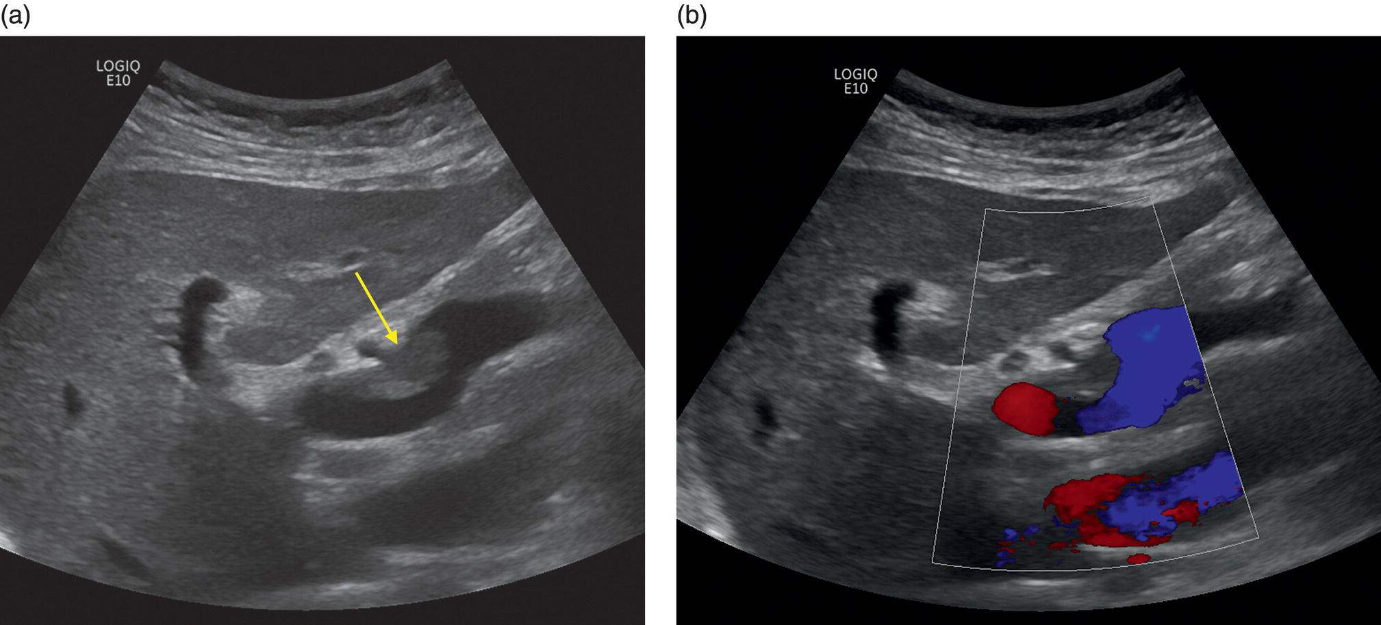 A set of two ultrasounds of a patient affected by partial portal vein thrombosis without cirrhosis. A. There is clot formation denoted by the arrow mark. B. Color Doppler exposes a flow in the lumen. The afflicted area is squared.