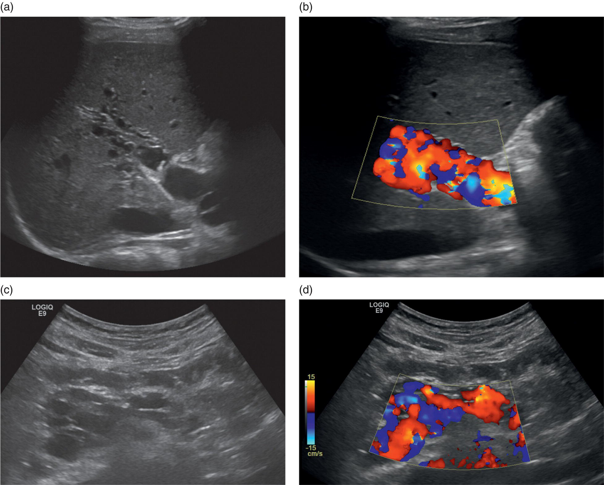 A set of four ultrasound images of a patient a. The intrahepatic portal vein is replaced by fibrous tissues. B. Hepatopetal flow with cavernous metamorphosis is visible on the color Doppler. C and d. There is an extrahepatic portal vein. The afflicted area is squared.