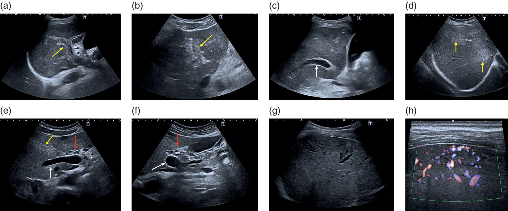 A set of eight ultrasounds of a patient on the changes in vascularity. A and b. It displays an acute portal vein thrombosis in the left and right branches of the portal vein, denoted by arrow C. It displays the posterior branch. D. Displays a poorly defined hyperechoic on the right hepatic lobe. e, f, g, and h. On the right lobe, they exposes the vascular alteration after three months.