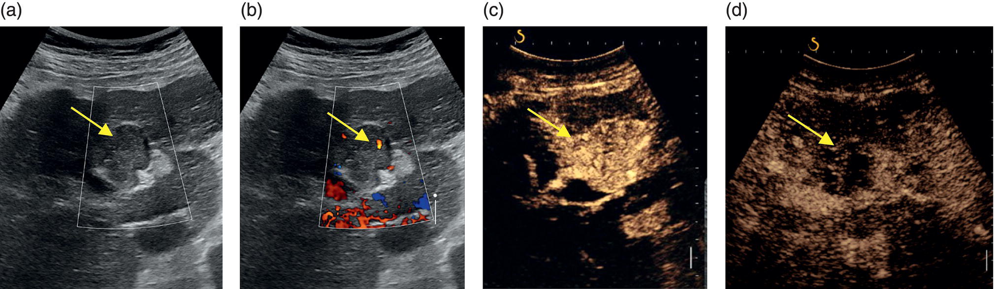 A set of four ultrasounds of a patient affected by neoplastic invasion on the left branch of the portal vein. A and b. An arterial flow is present and there is a wall disruption with clot development. C. Large tumor exposure. D. The arrow indicates a neoplastic invasion of the portal vein.