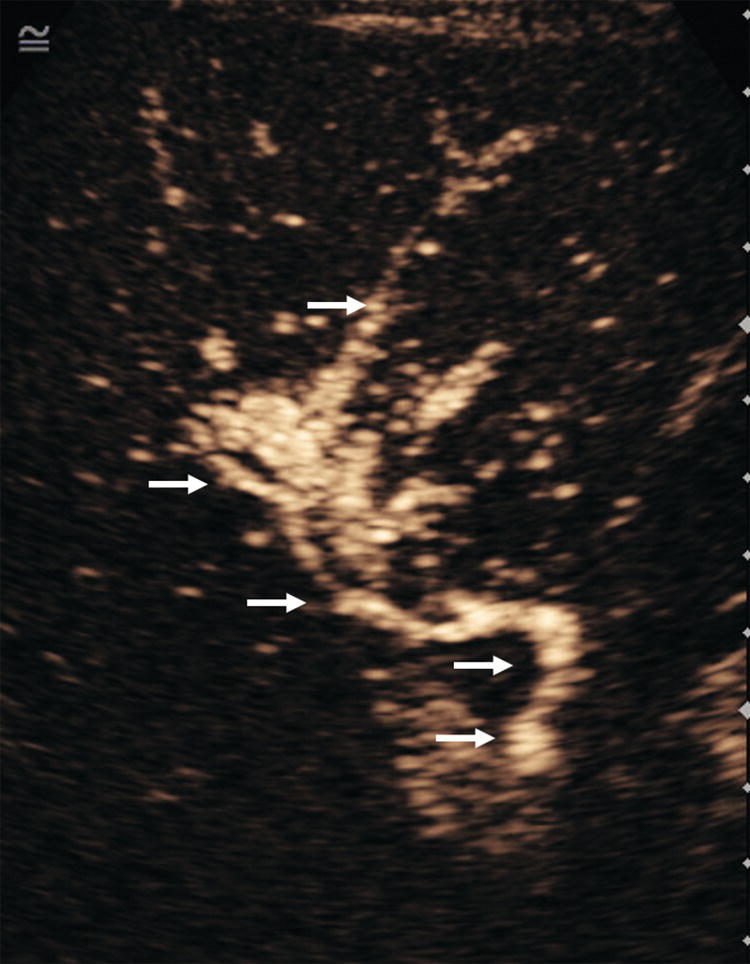 An ultrasound scan image depicts the hepatic artery to assess the artery of the portal vein and liver parenchyma. The hepatic arteries are highlighted with arrows.