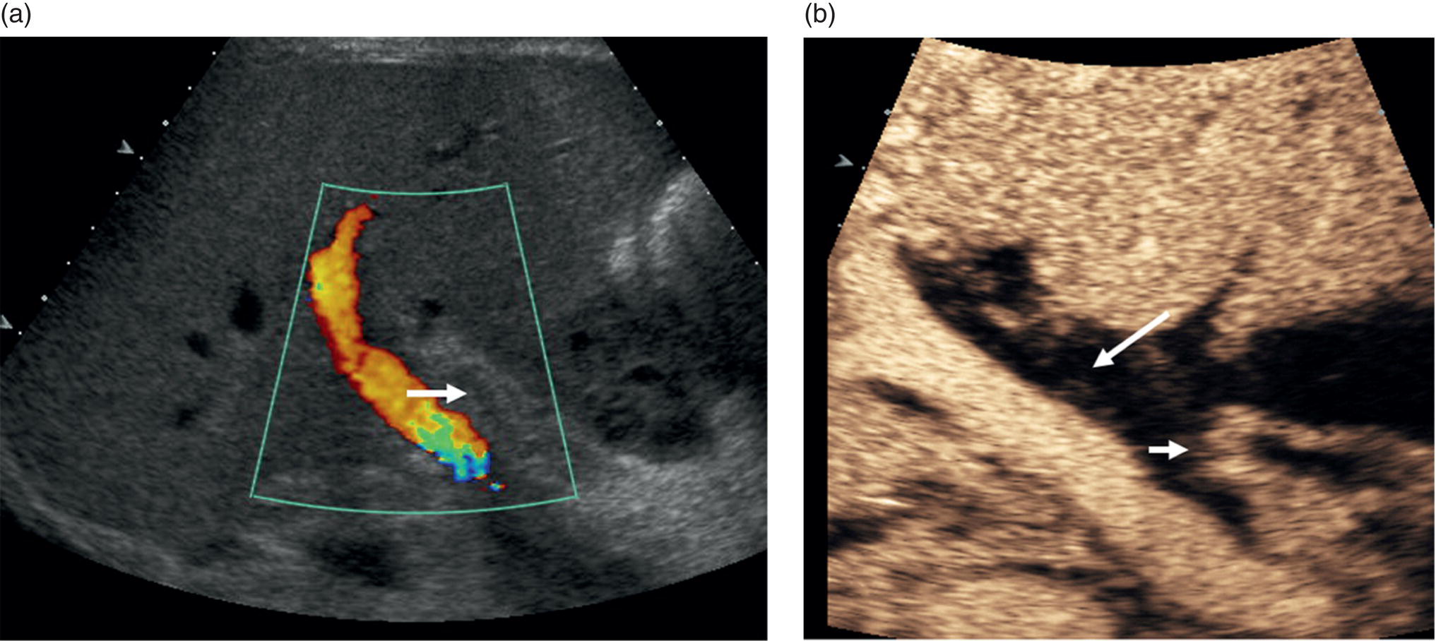 Two ultrasound scan images depict the portal vein in color Doppler, the position of the hepatic artery is highlighted with an arrow. The coeliac axis and splenic artery in the hepatic artery with an acute artery thrombosis are depicted.
