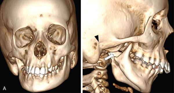 Imaging of masticator space | Radiology Key