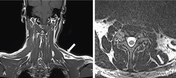 Lower Cranial Nerves Imaging (9–12th Nerves) 