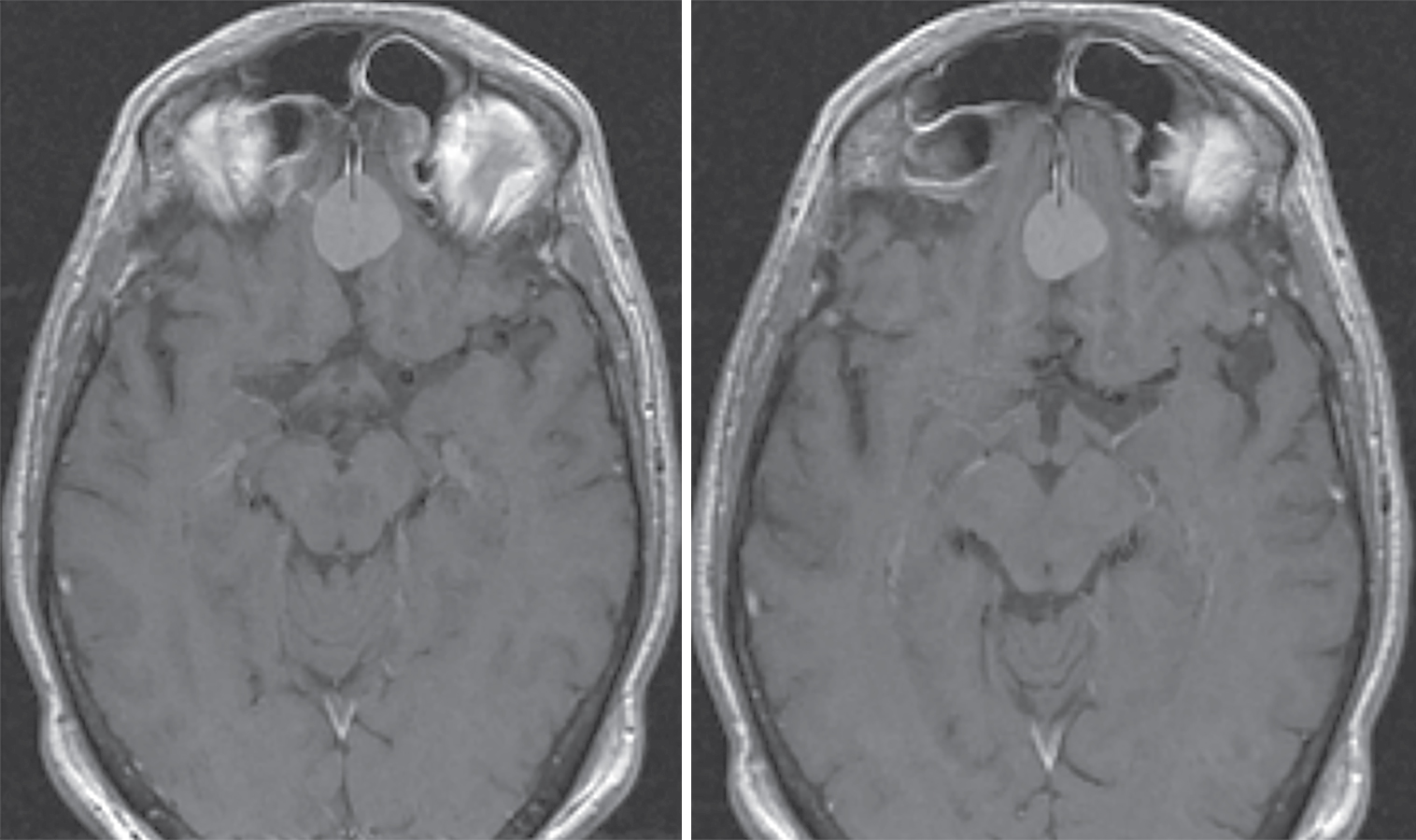 Olfactory groove meningioma – upfront radiosurgery | Radiology Key