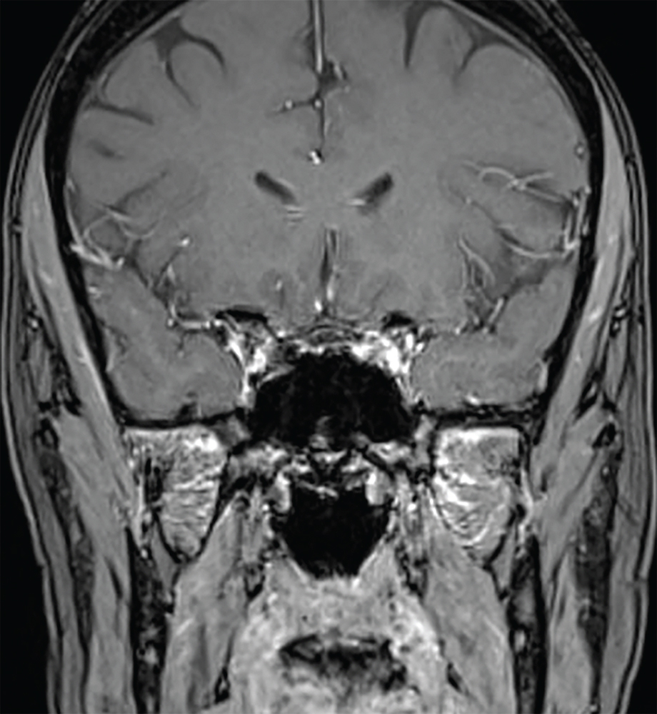 Acth Secreting – Delayed Postoperative Radiosurgery Of Gland For 