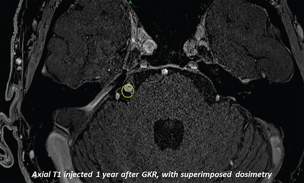 Cisternal trigeminal schwannoma – upfront radiosurgery | Radiology Key