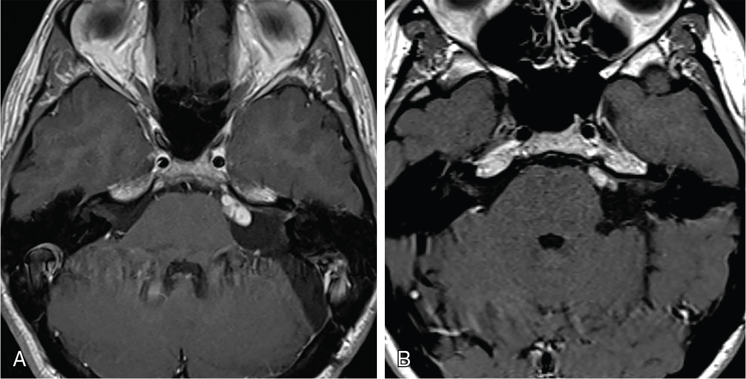 Large vestibular schwannoma – delayed postoperative radiosurgery for ...