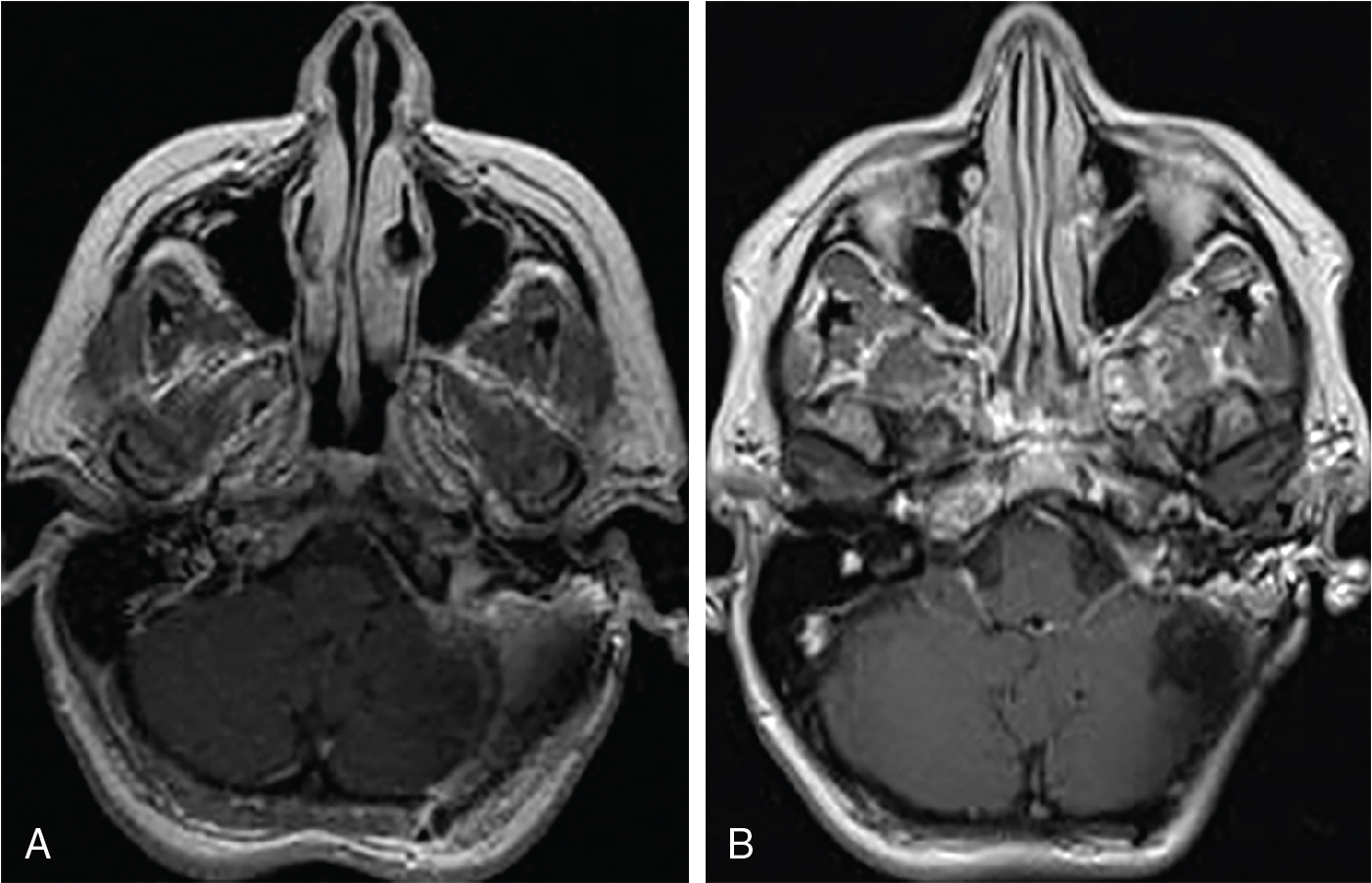 Jugular foramen/sigmoid sinus meningioma – postoperative radiosurgery ...