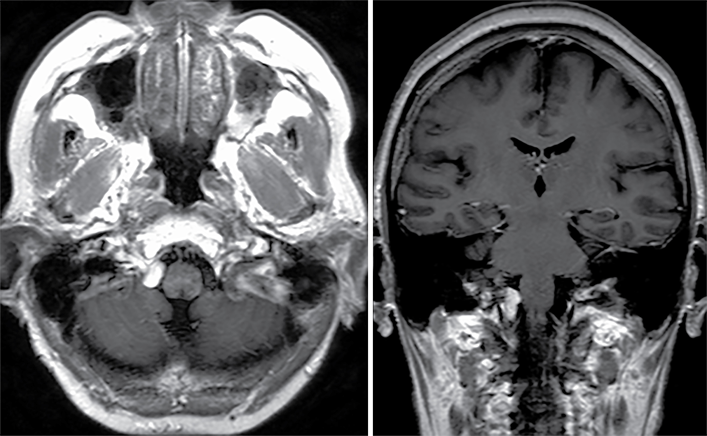 Foramen magnum meningioma – upfront radiosurgery | Radiology Key