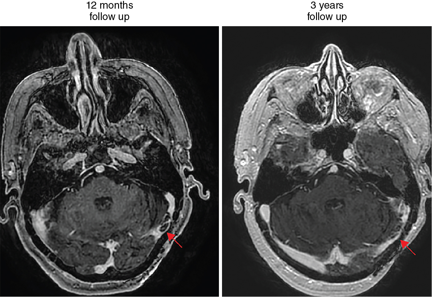 Transverse sinus dural arteriovenous fistula – upfront, preembolization ...