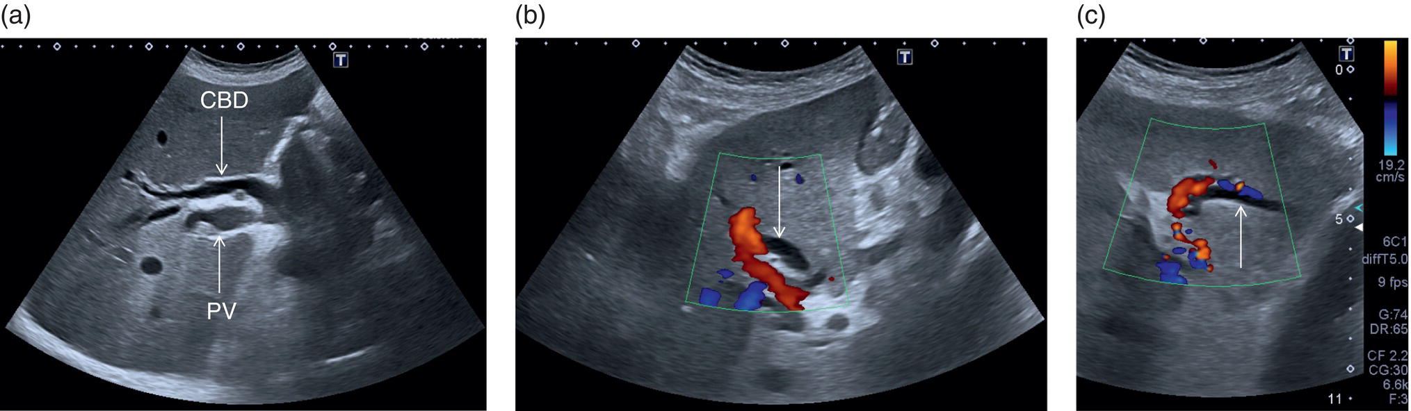 A radiograph image. It depicts the portal vein lies to the common bile duct and the hepatic hilum is marked with arrows.